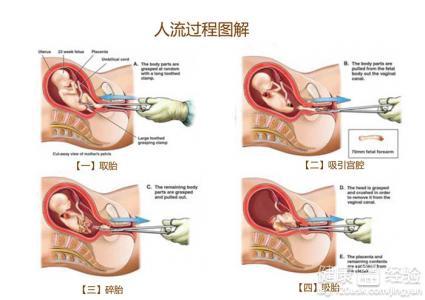 关于一个月是否可以做药流，深度解析与全面探讨