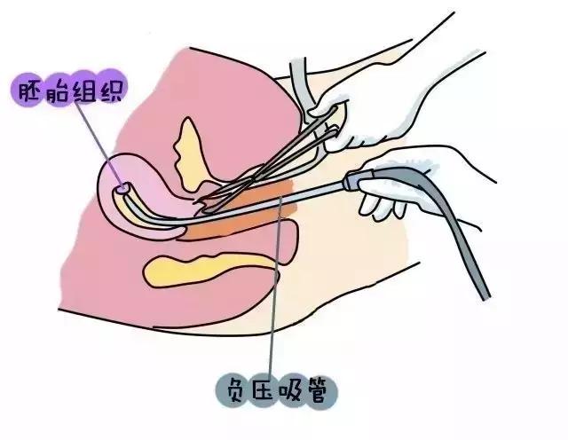 三个月药流流出胎儿全过程详解及胎儿图展示