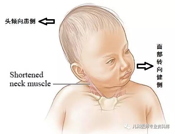 四个月宝宝斜颈治疗指南