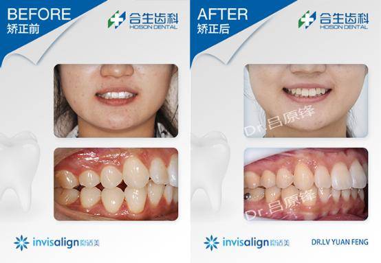 广东省口腔隐适美，引领隐形矫正新潮流