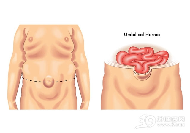 两个月宝宝肚脐疝图，了解、预防与处理